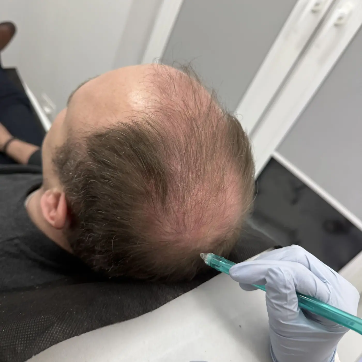 Terapia skóry głowy